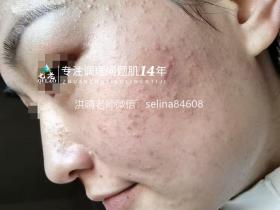 七老脂皮痘痘修护案例