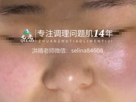 七老红烫痒痛疹子修护案例