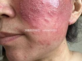 七老严重激素脸玫瑰痤疮修护案例