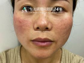 七老激素脸修护案例