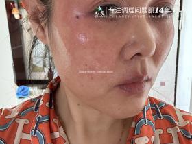 七老激素脸红烫痒修护案例