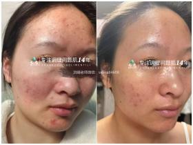 七老油敏痘痘痘肌修护案例