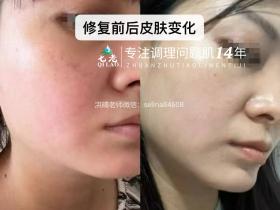 七老大红脸修护案例