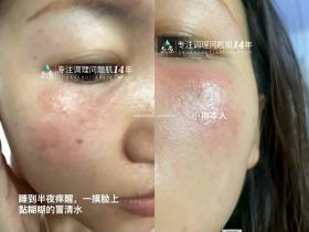 七老突发过敏修护案例