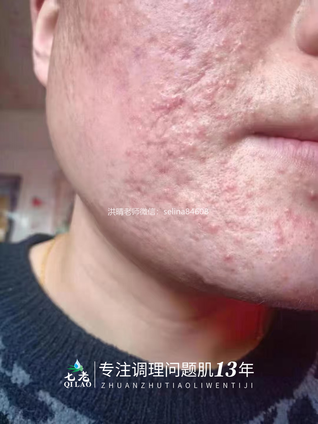 七老激素痘修护案例