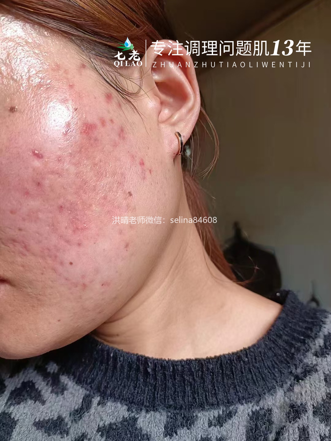 七老激素痘修护案例