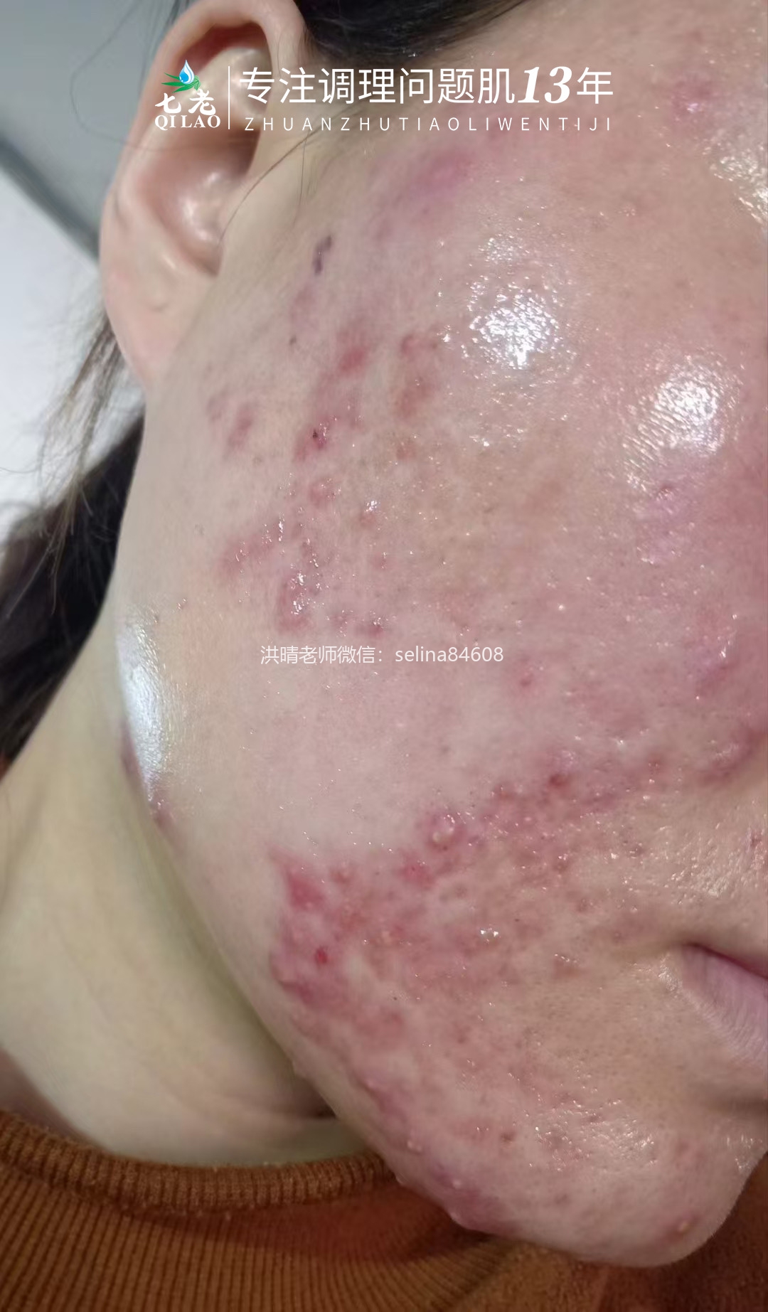 七老激素痘修护案例