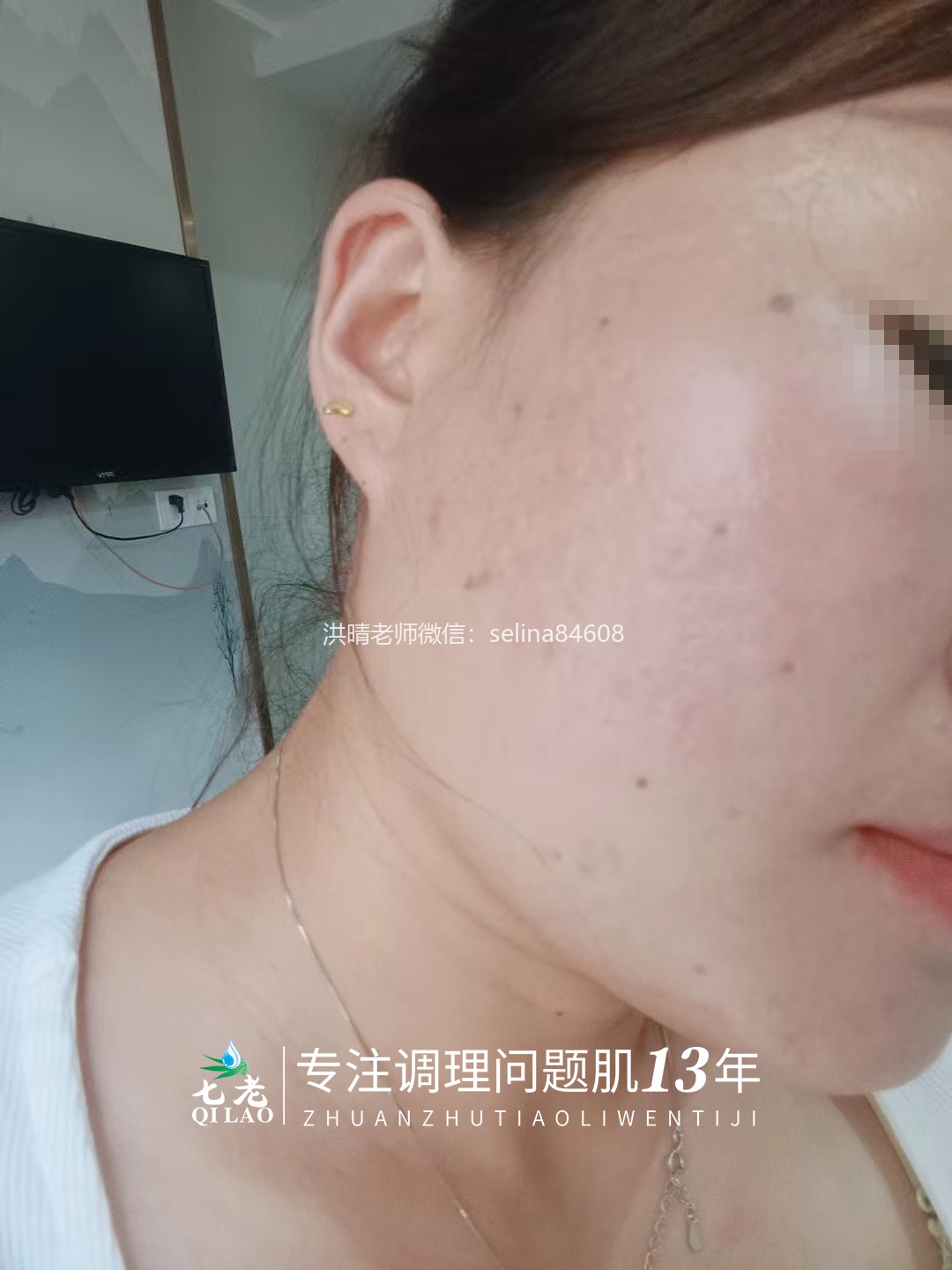 七老激素痘修护案例