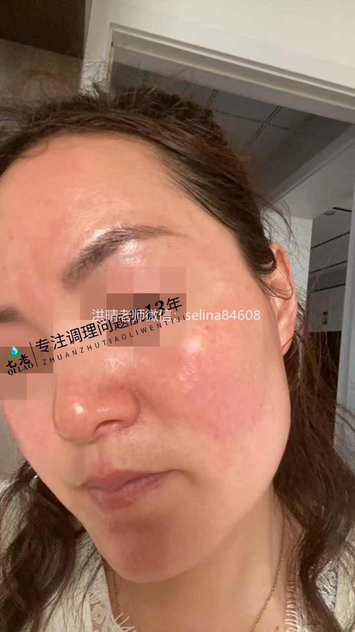七老激素脸玫瑰修护案例