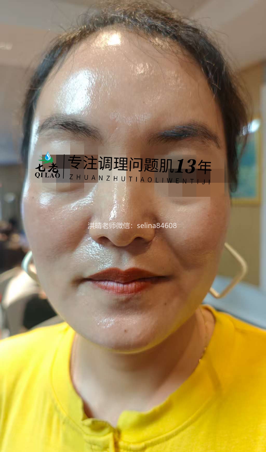 七老激素脸玫瑰修护案例