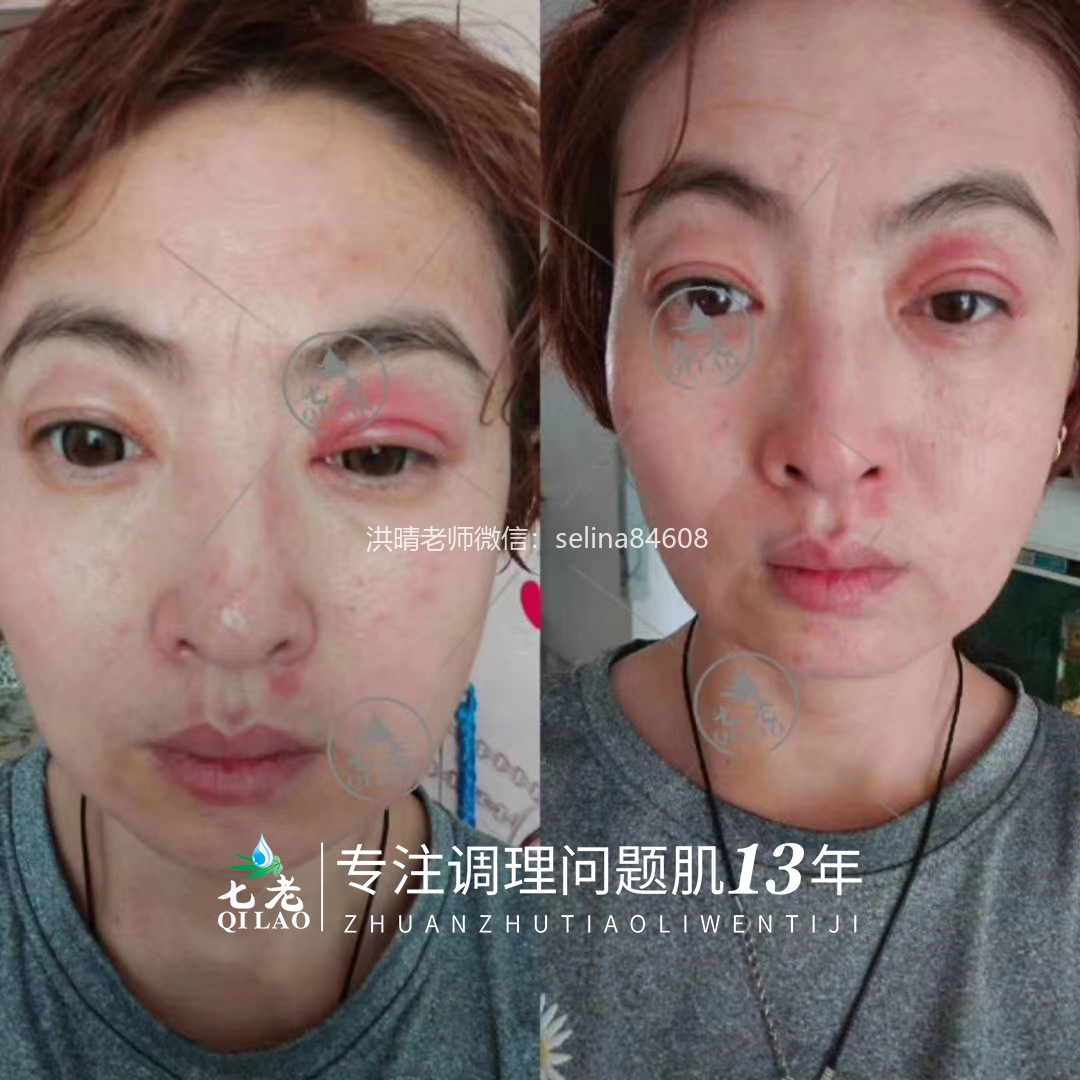 七老激素脸红肿痒疹子眼睛反复过敏修护案例