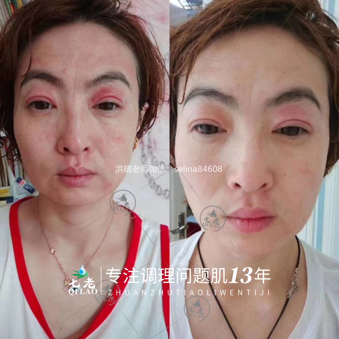七老激素脸红肿痒疹子眼睛反复过敏修护案例