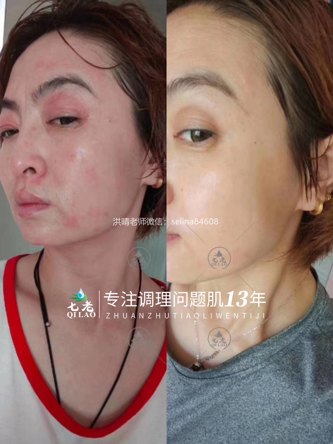七老激素脸红肿痒疹子眼睛反复过敏修护案例