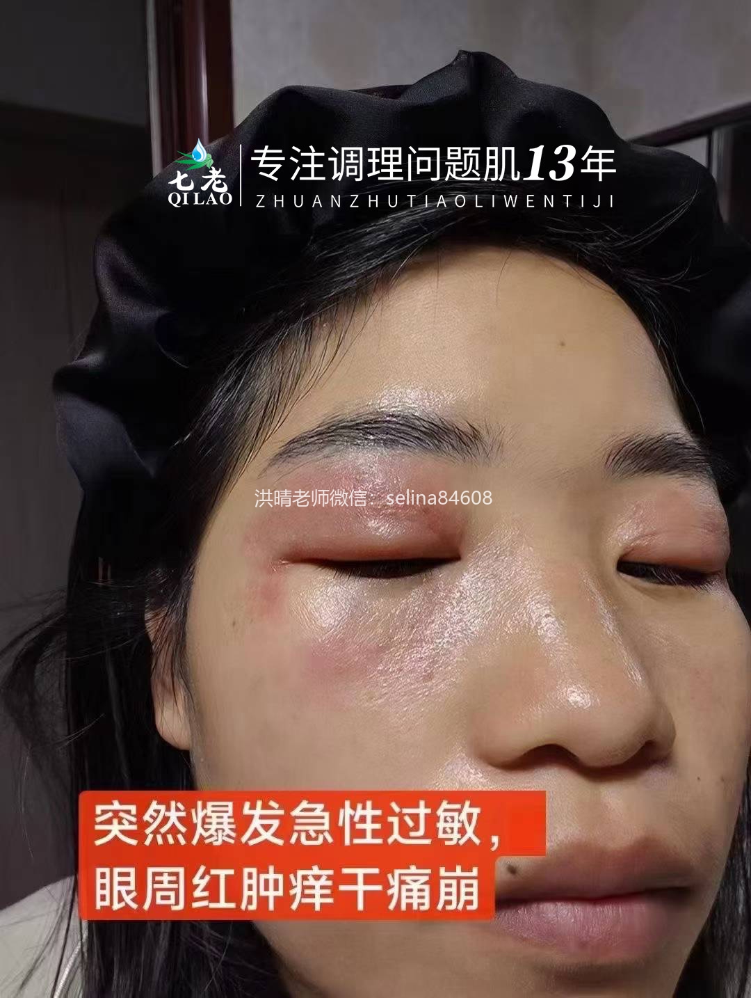七老眼睛眼周红肿痒疹子过敏修复案例