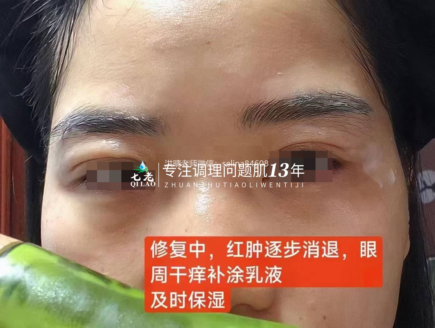 七老眼睛眼周红肿痒疹子过敏修复案例