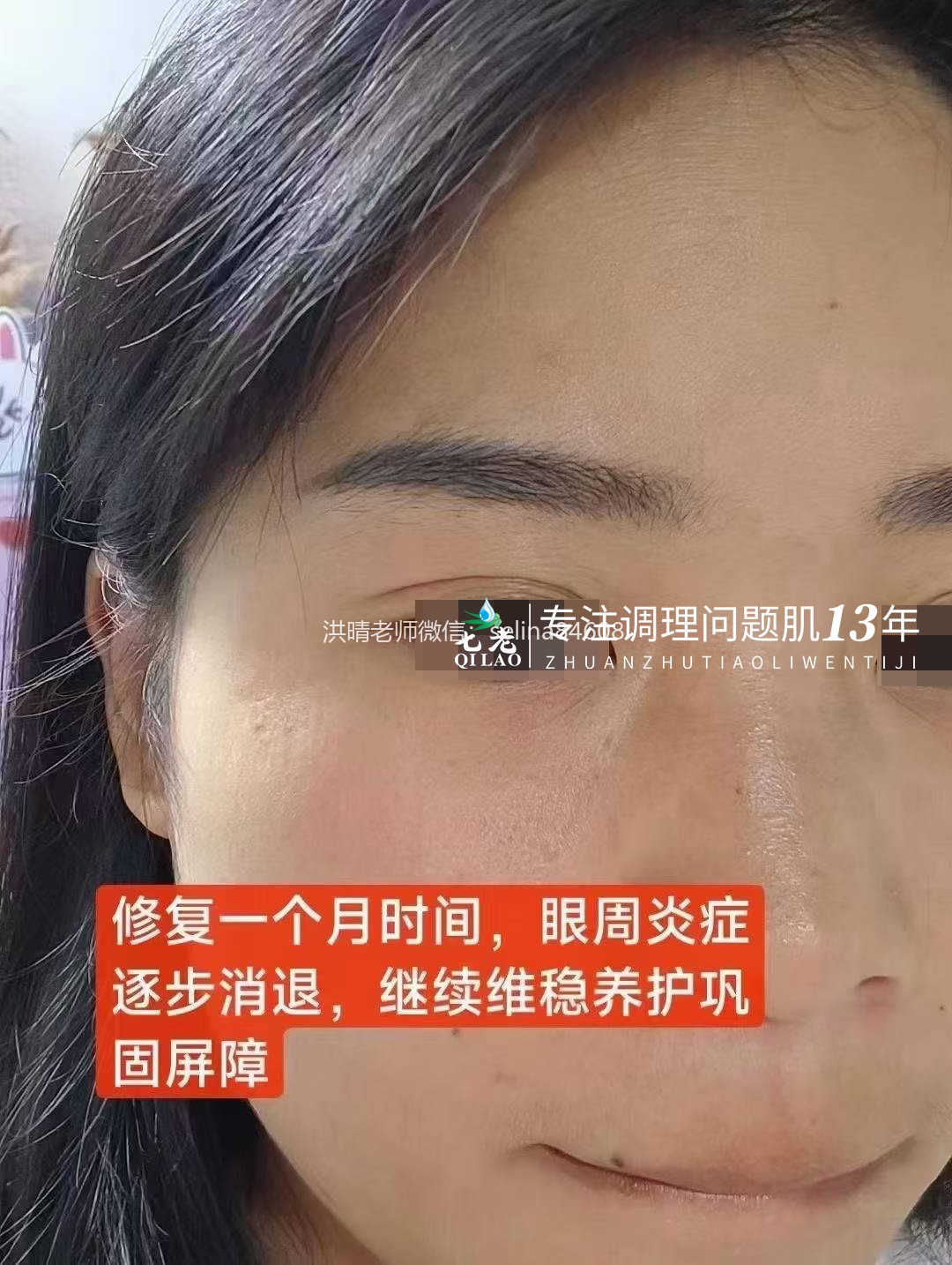 七老眼睛眼周红肿痒疹子过敏修复案例