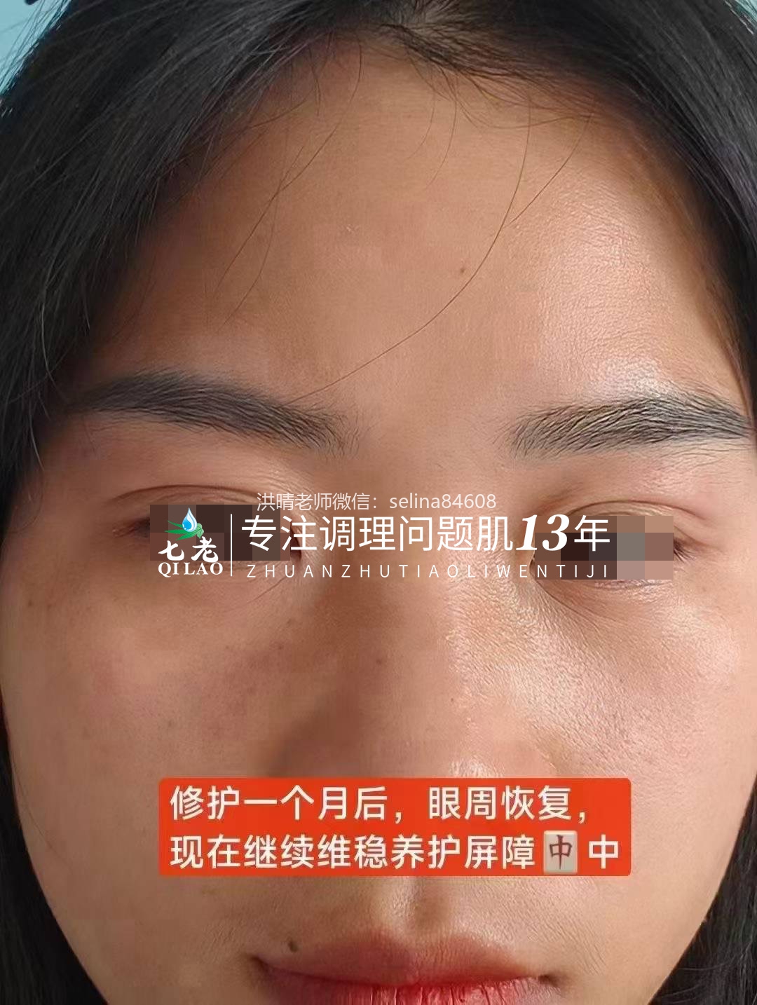 七老眼睛眼周红肿痒疹子过敏修复案例