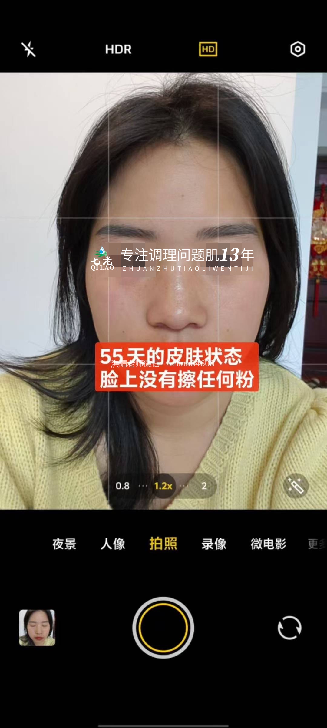 七老眼睛眼周红肿痒疹子过敏修复案例
