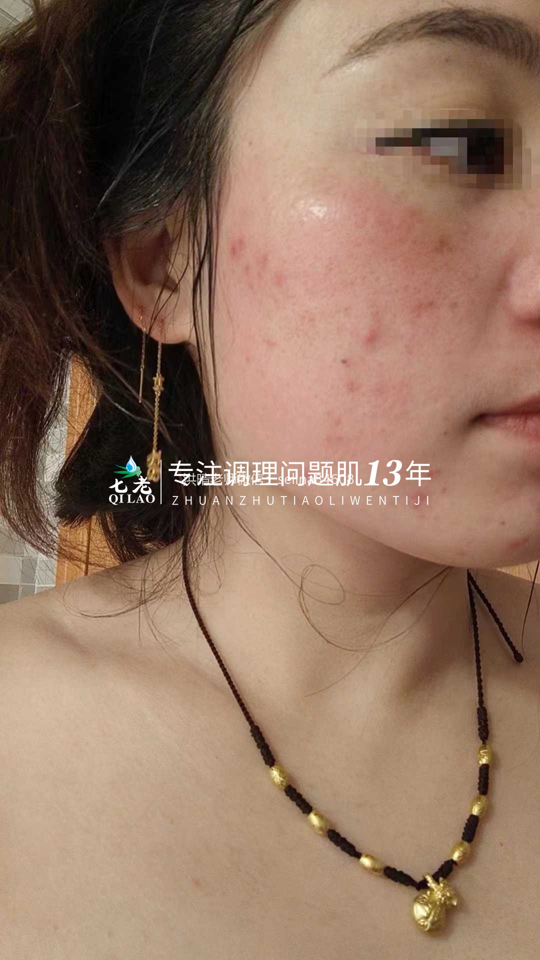 油敏痘疹子的修护关键