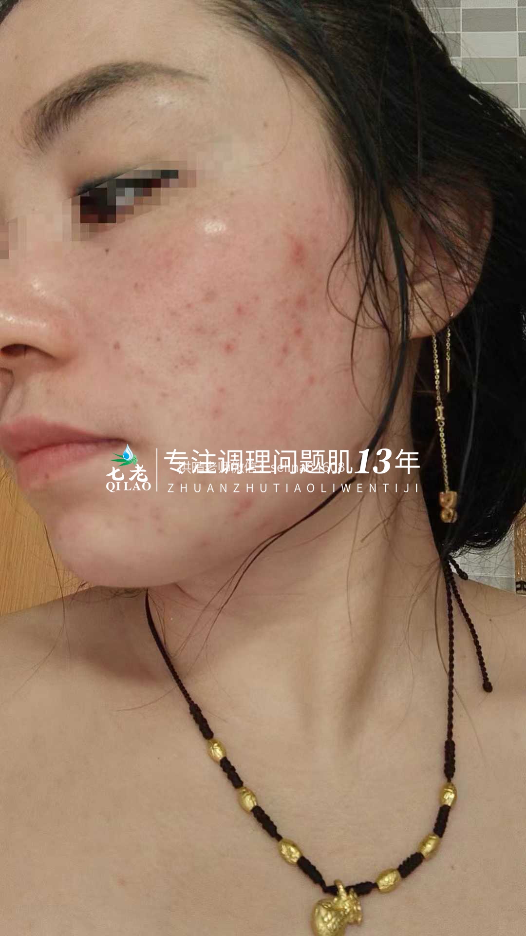 油敏痘疹子的修护关键