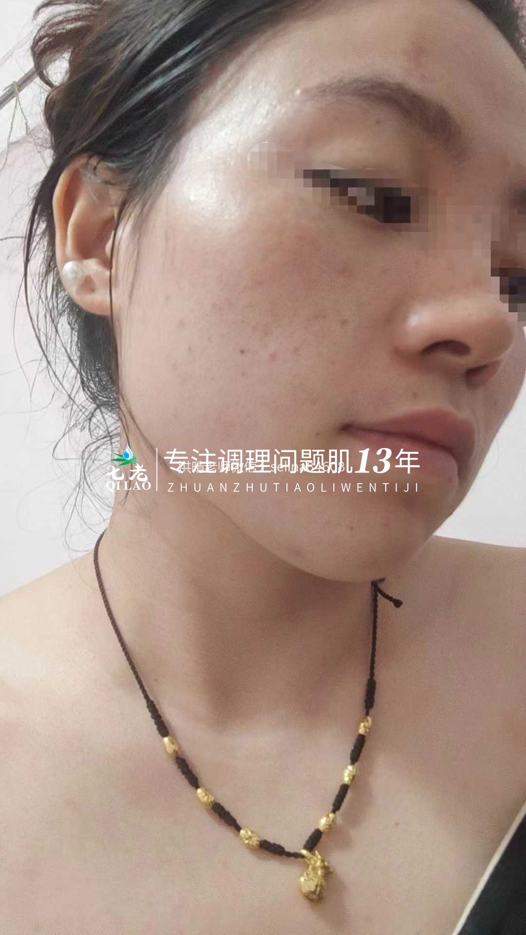 油敏痘疹子的修护关键