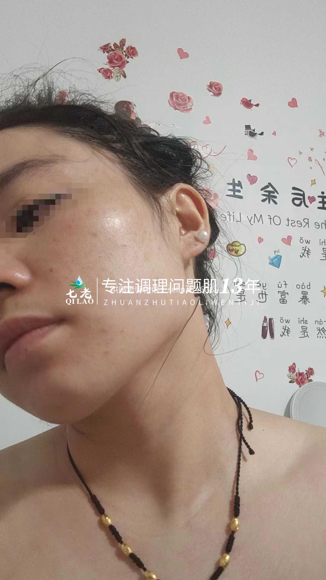 油敏痘疹子的修护关键
