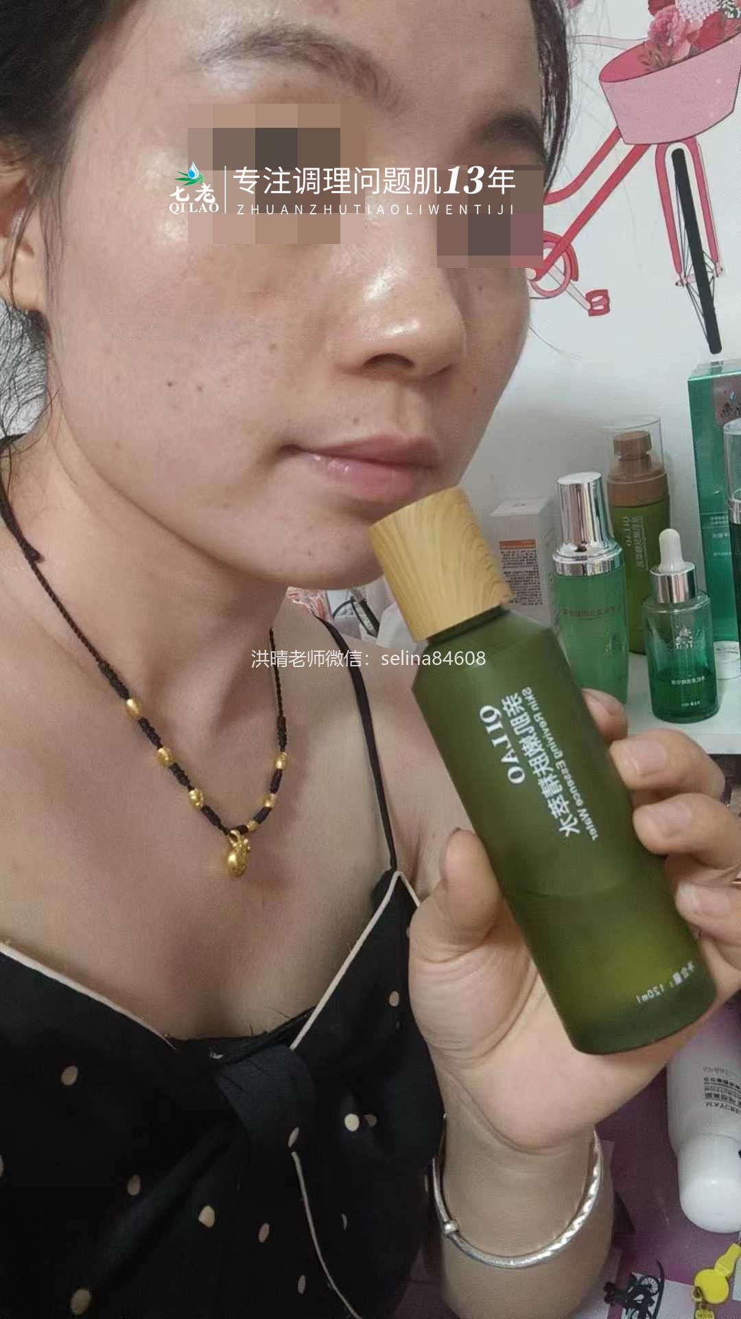 油敏痘疹子的修护关键