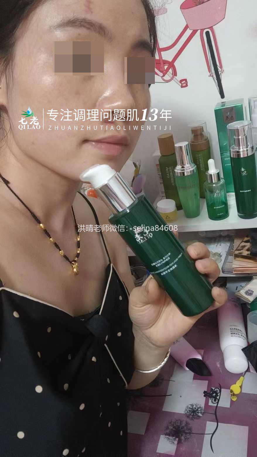 油敏痘疹子的修护关键