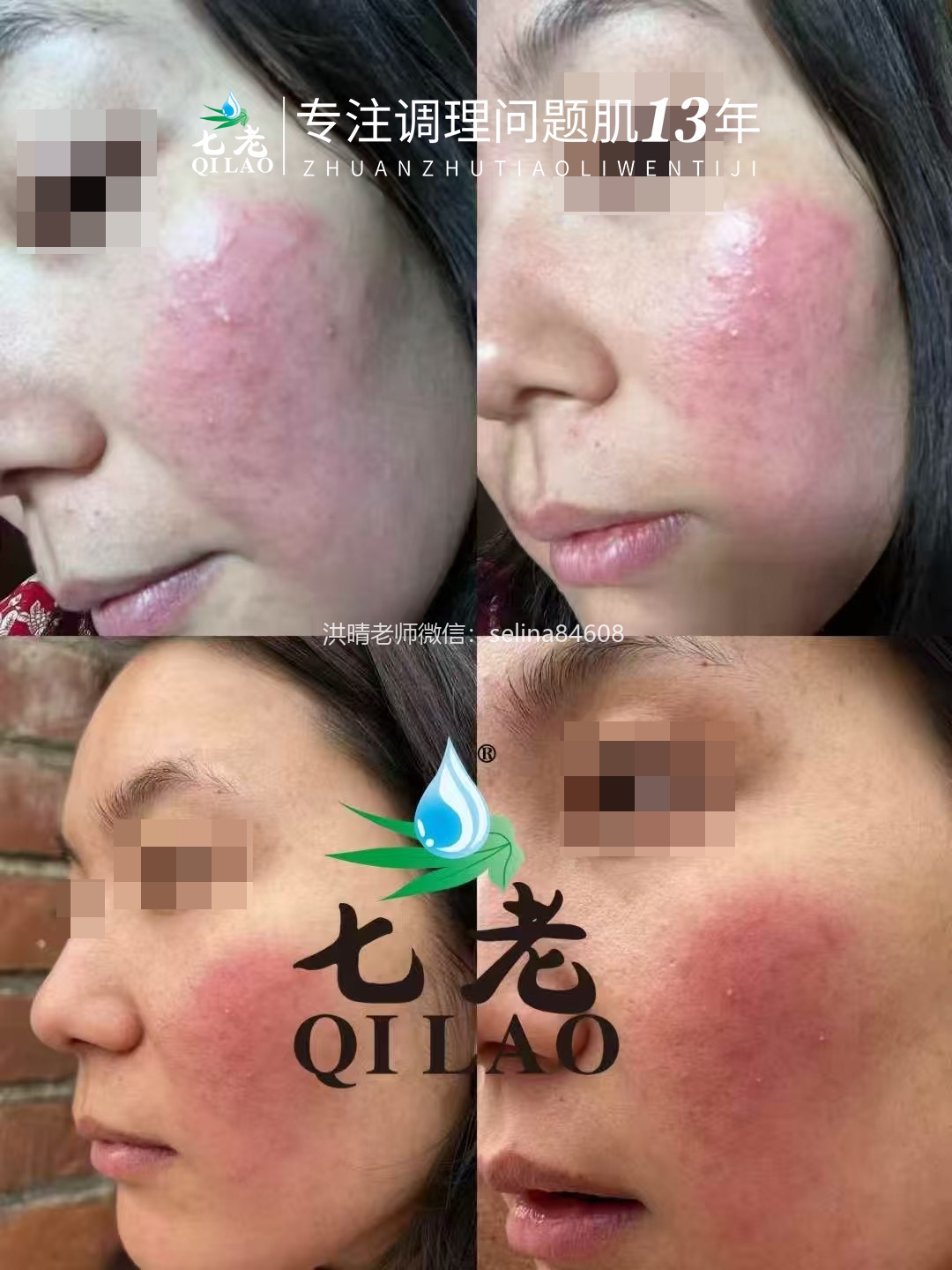 七老激素脸修复案例