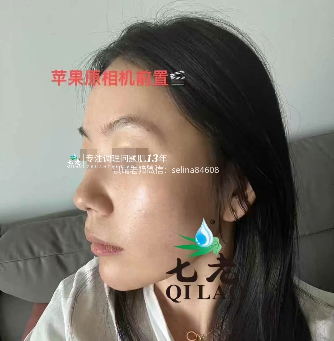 七老激素脸修复案例