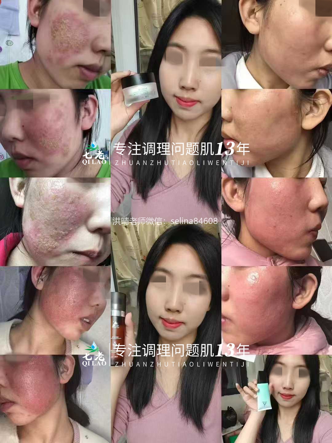 七老激素脸修复案例