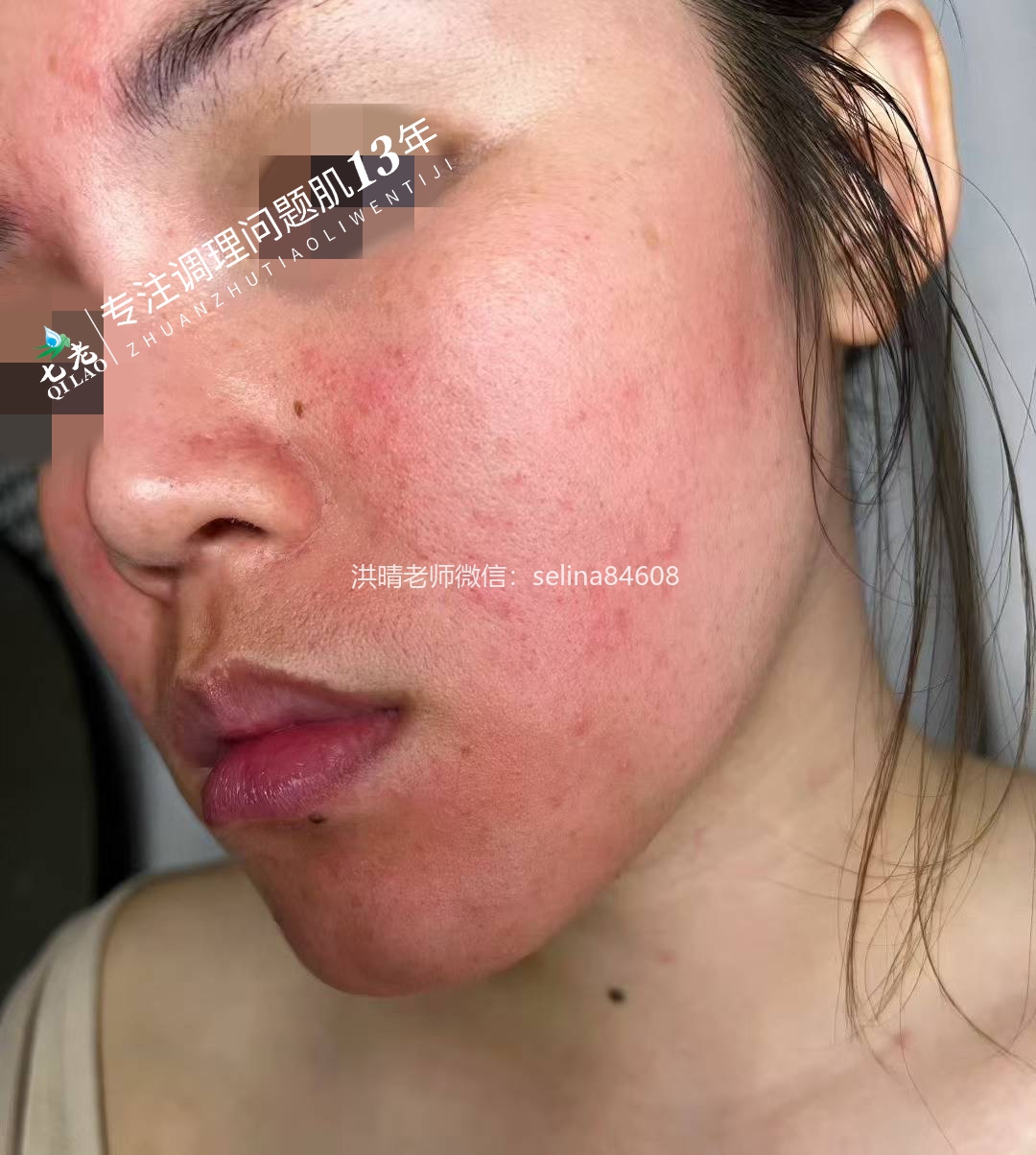 七老红烫痒疹子修护案例
