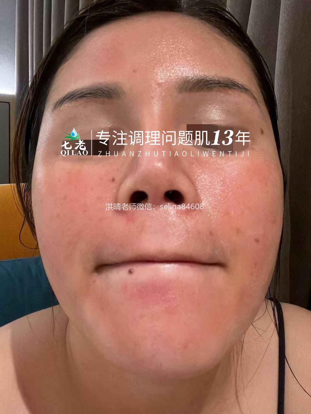 七老红烫痒疹子修护案例