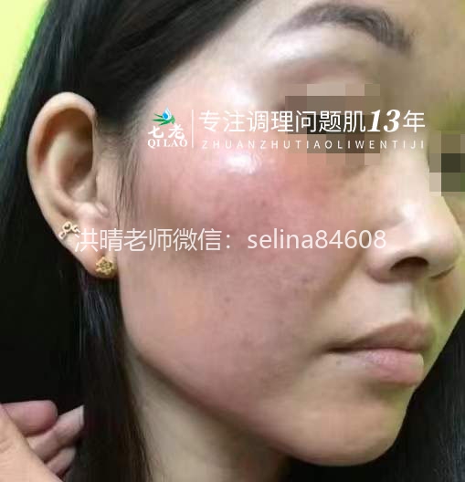 七老剥脱祛斑发红发烫大红脸修复案例