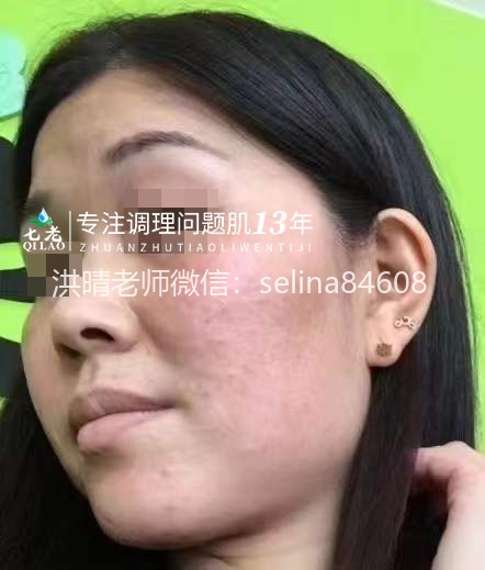 七老剥脱祛斑发红发烫大红脸修复案例