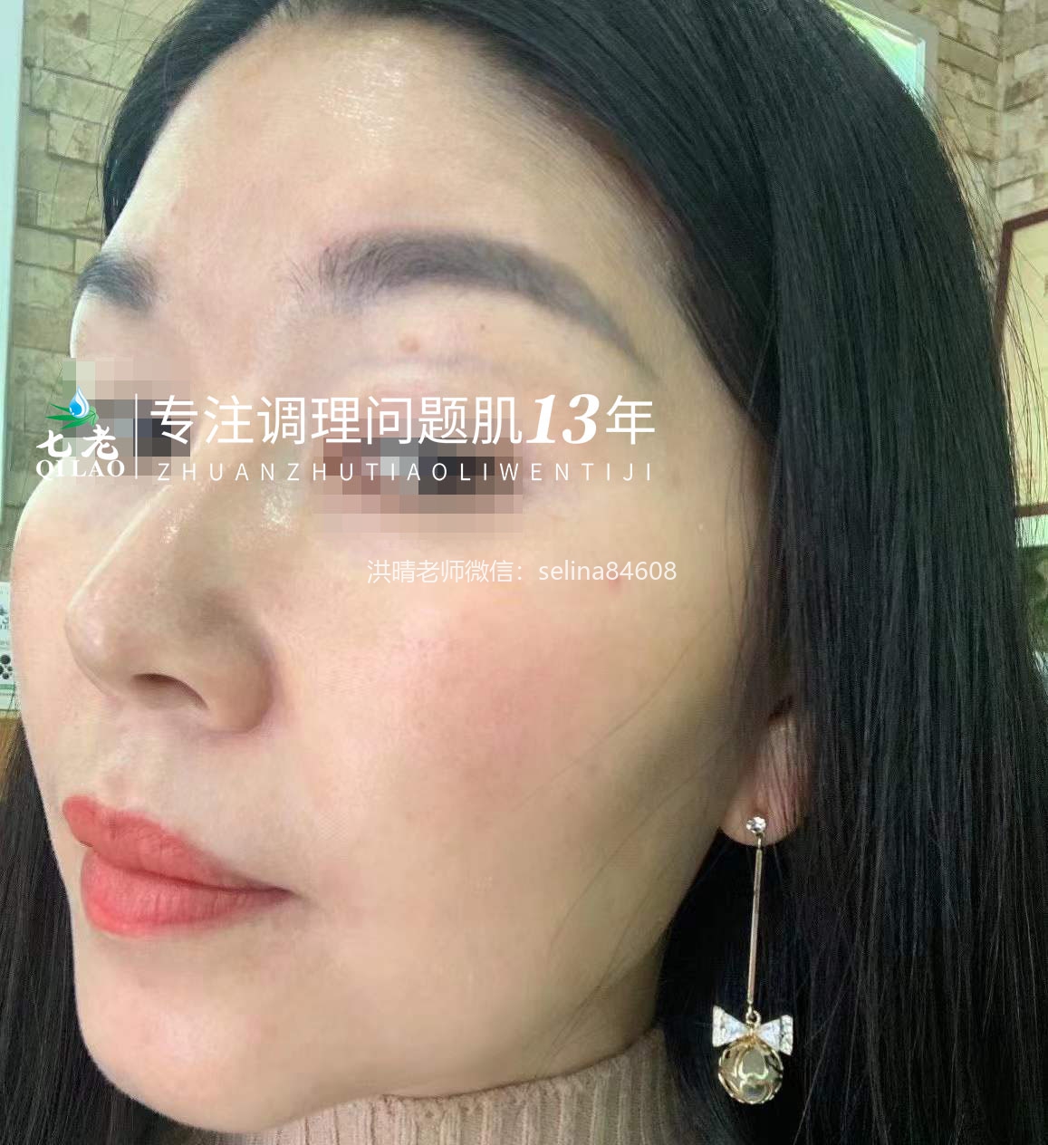 七老剥脱祛斑发红发烫大红脸修复案例
