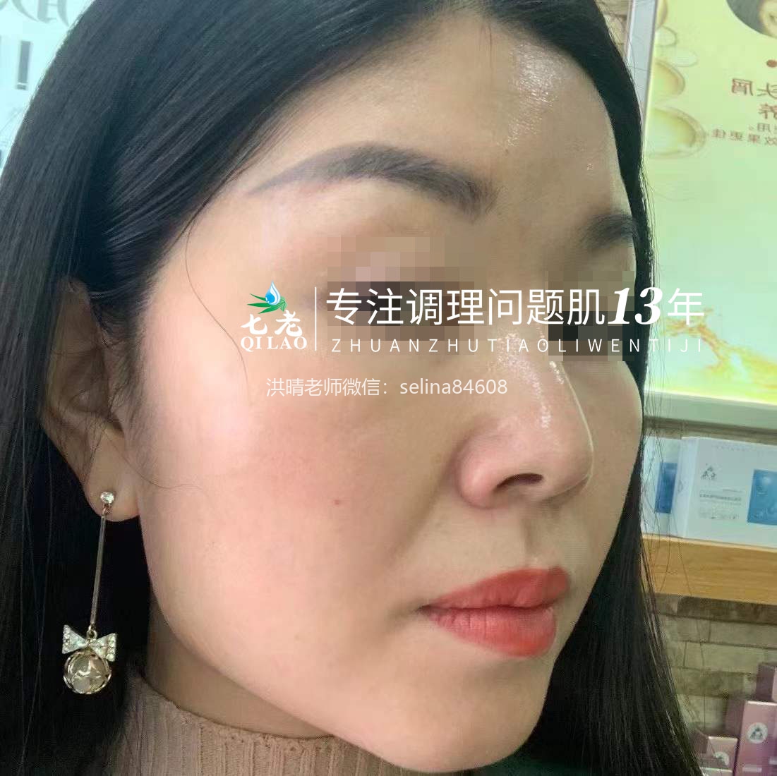 七老剥脱祛斑发红发烫大红脸修复案例