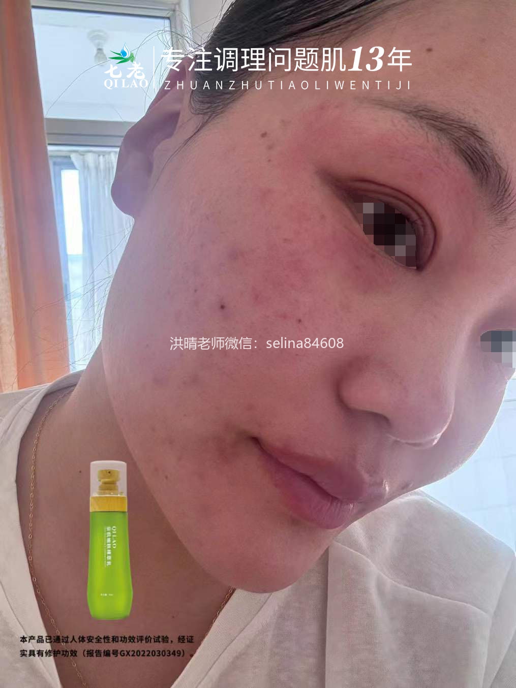 七老激素脸反复过敏修复案例