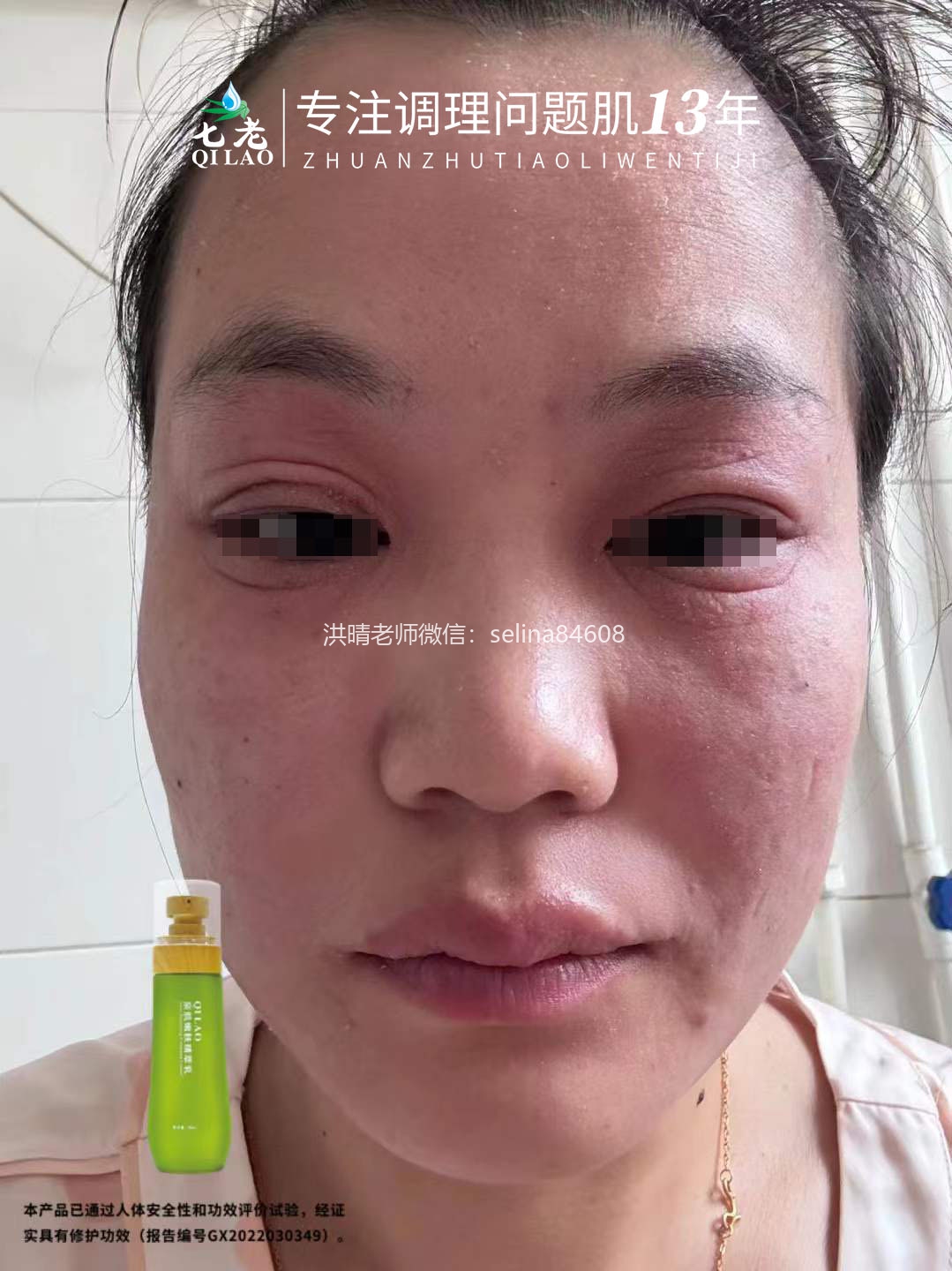 七老激素脸反复过敏修复案例
