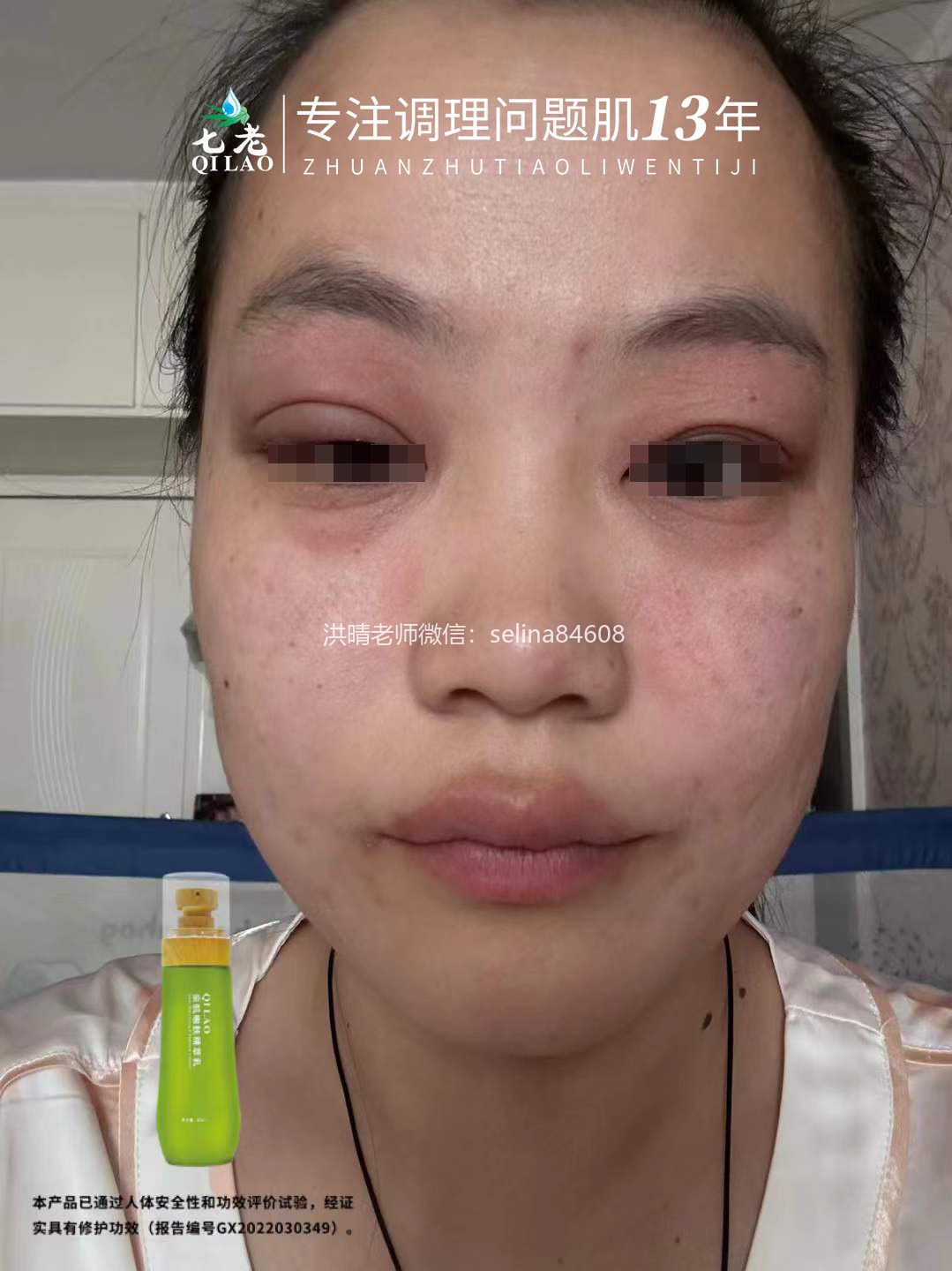 七老激素脸反复过敏修复案例