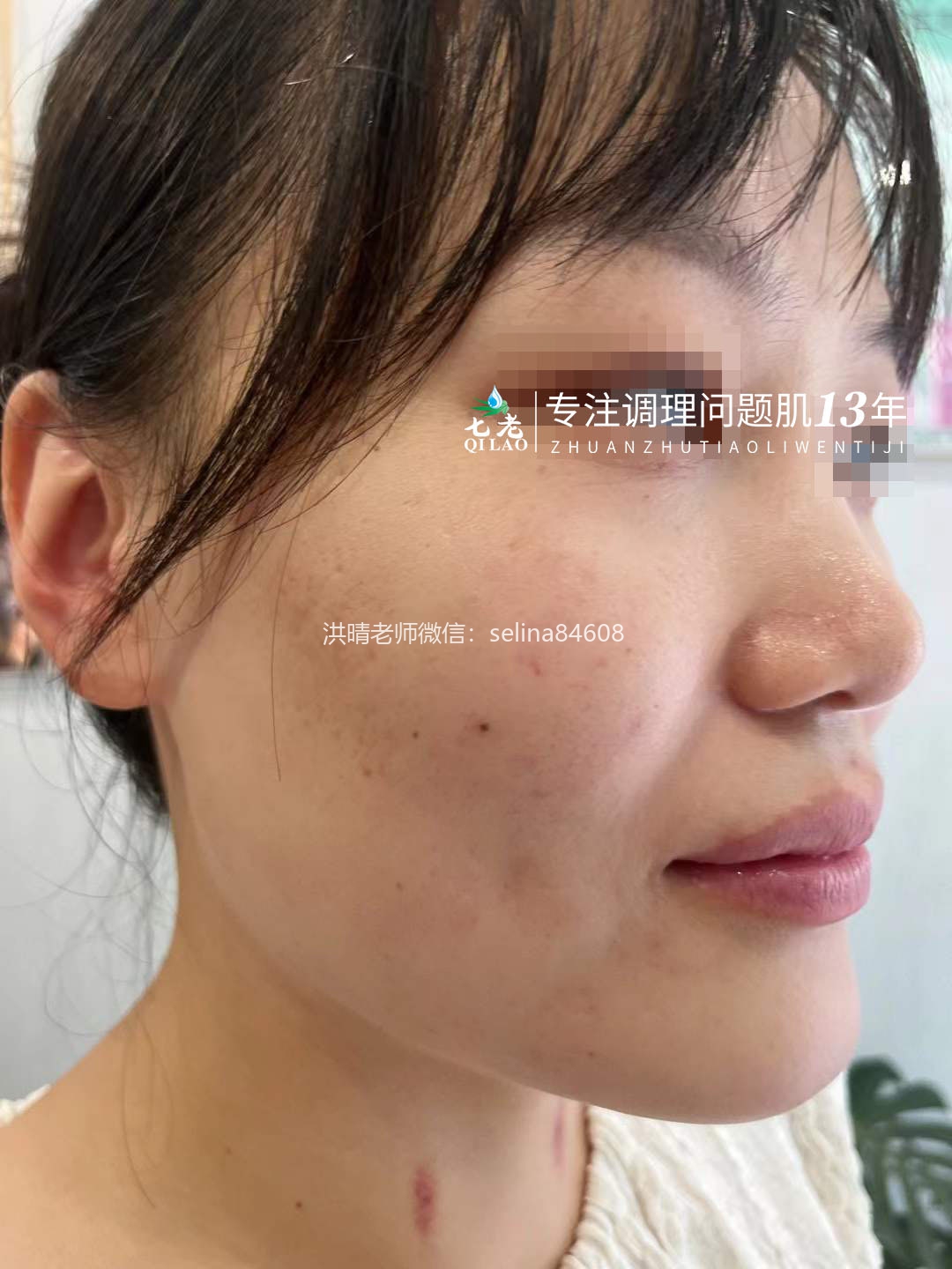 七老激素脸反复过敏修复案例
