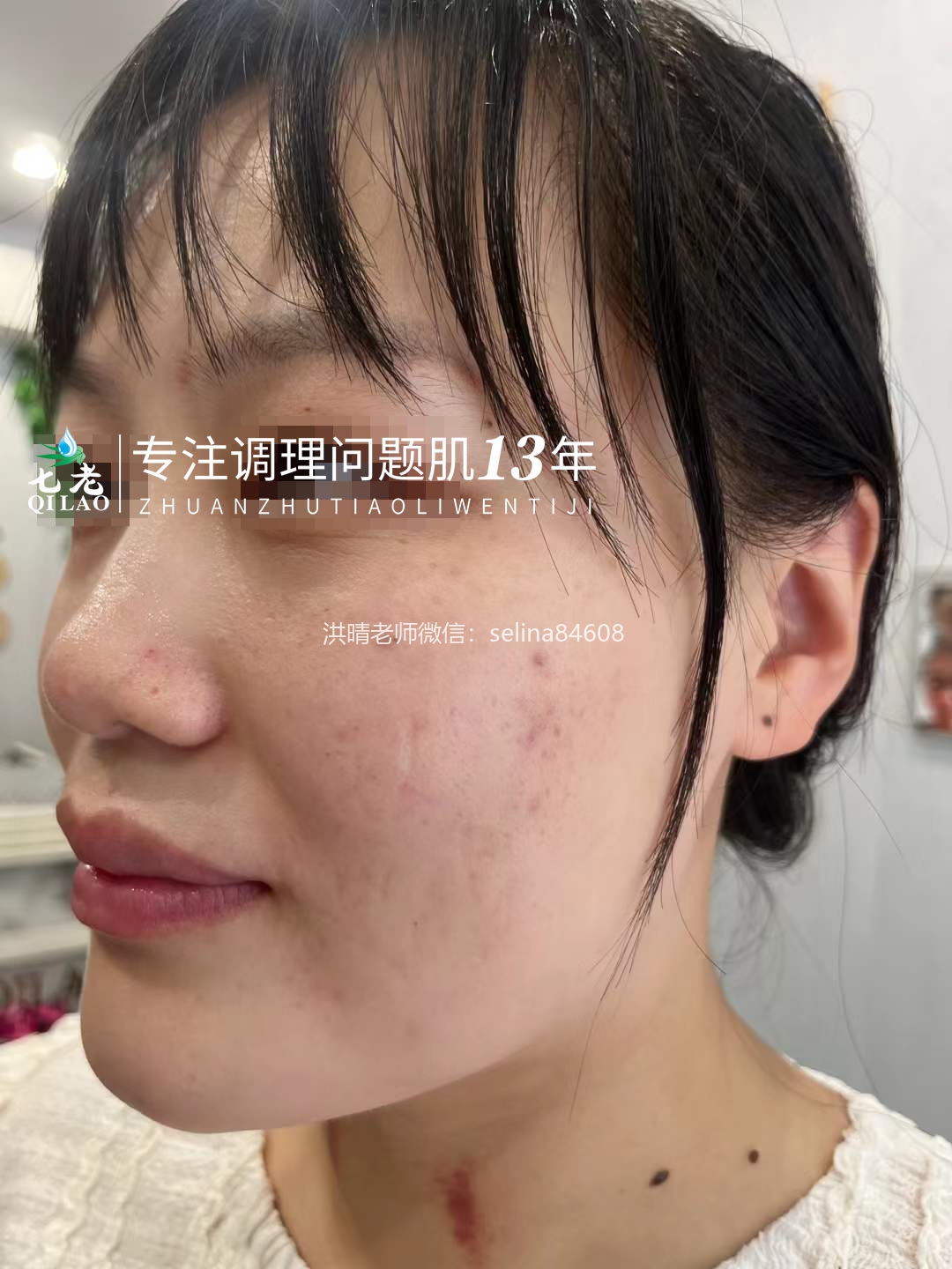 七老激素脸反复过敏修复案例