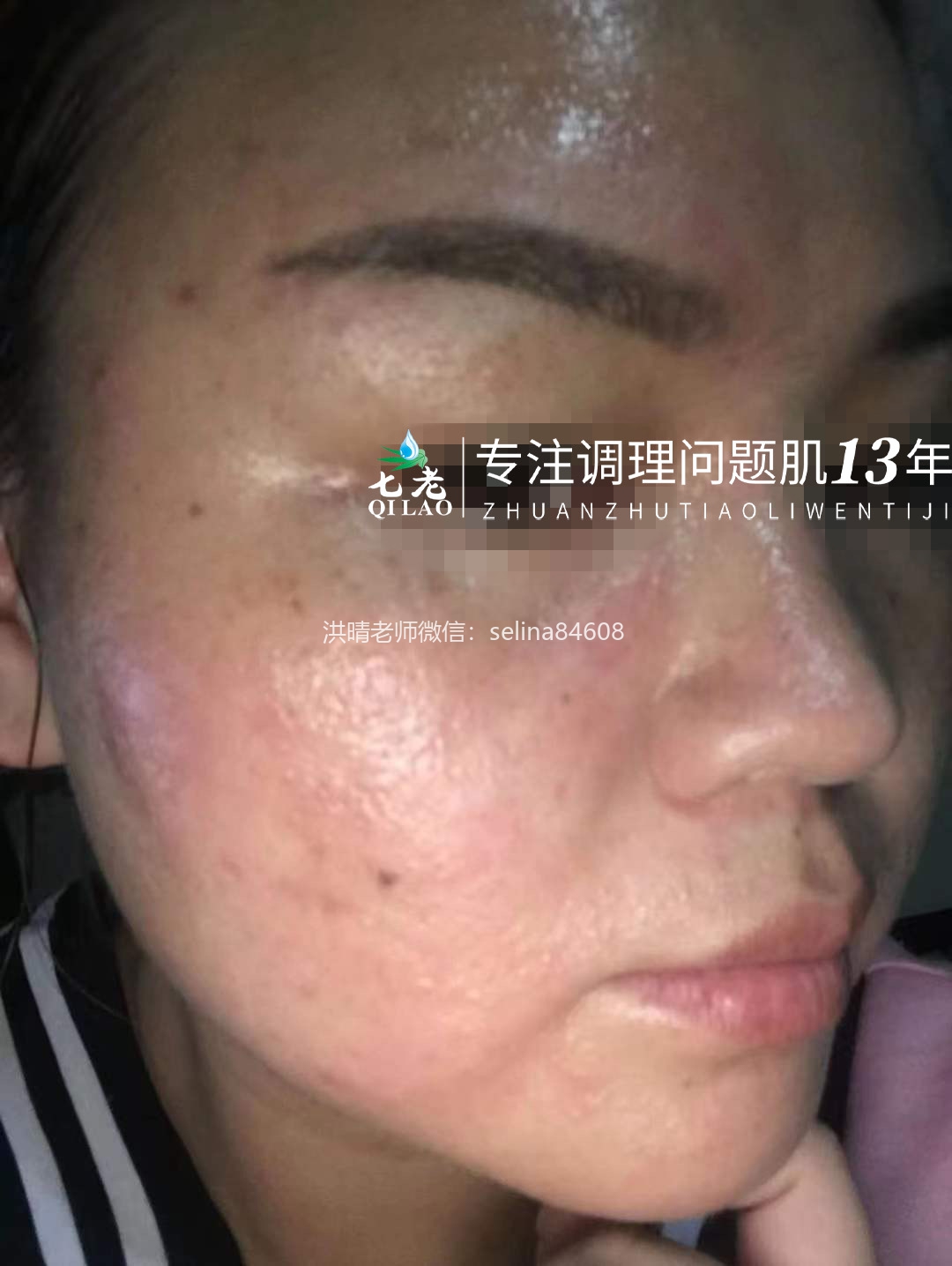 七老脂溢性皮炎修复案例