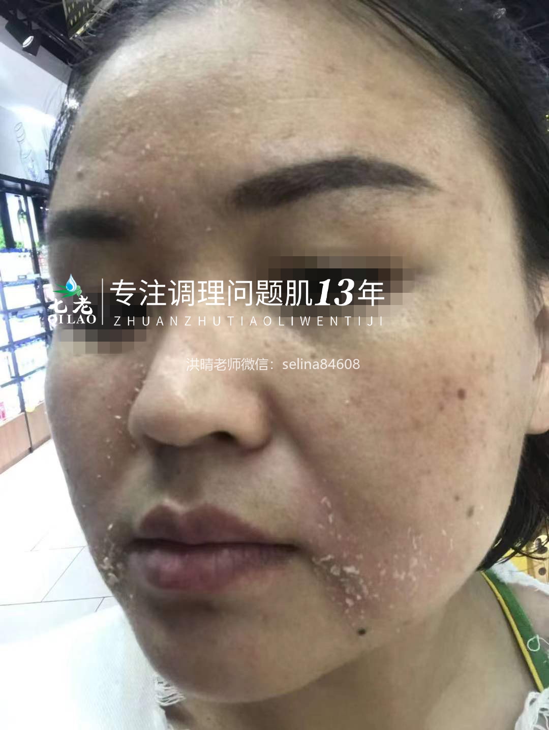 七老脂溢性皮炎修复案例