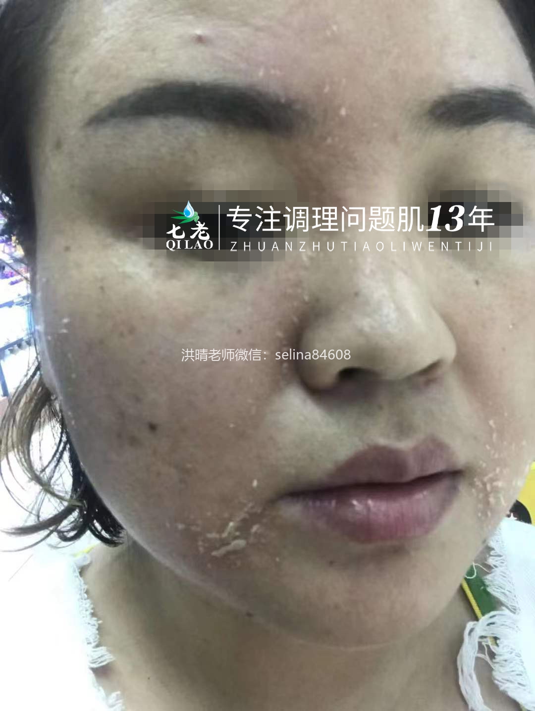 七老脂溢性皮炎修复案例