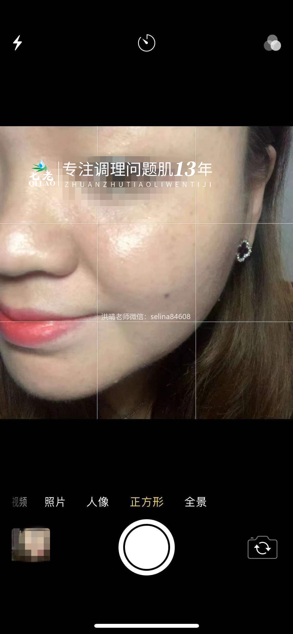 七老脂溢性皮炎修复案例
