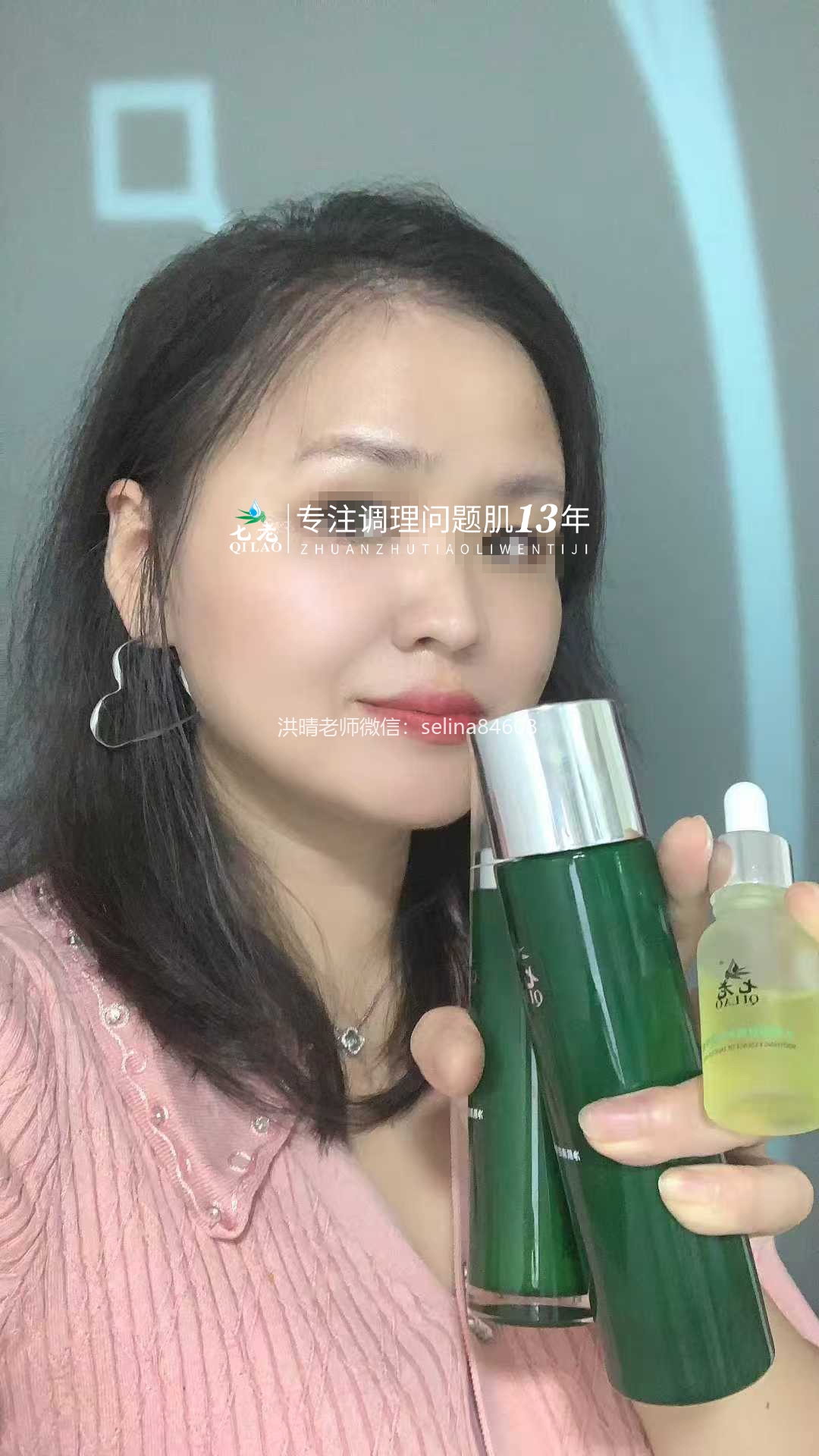 七老脂溢性皮炎修复案例