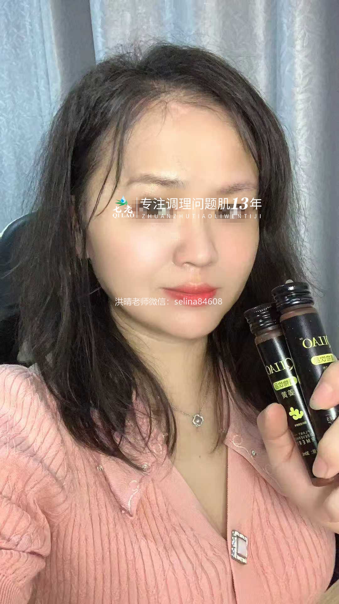 七老脂溢性皮炎修复案例
