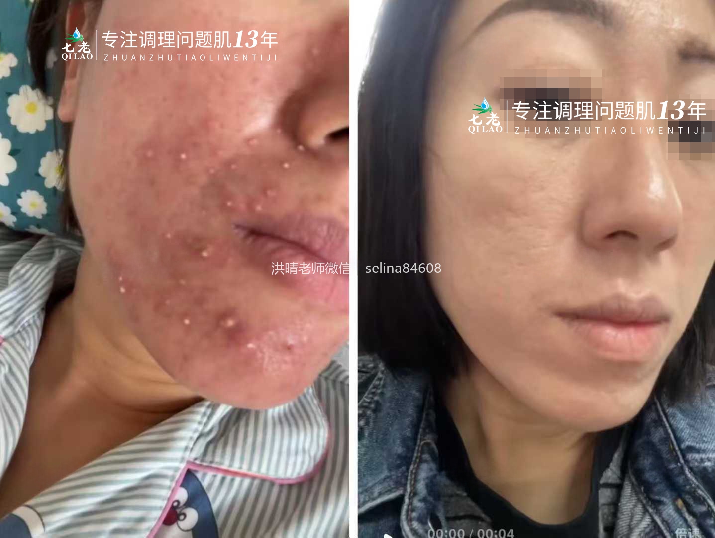 激素脸痘痘修护案例