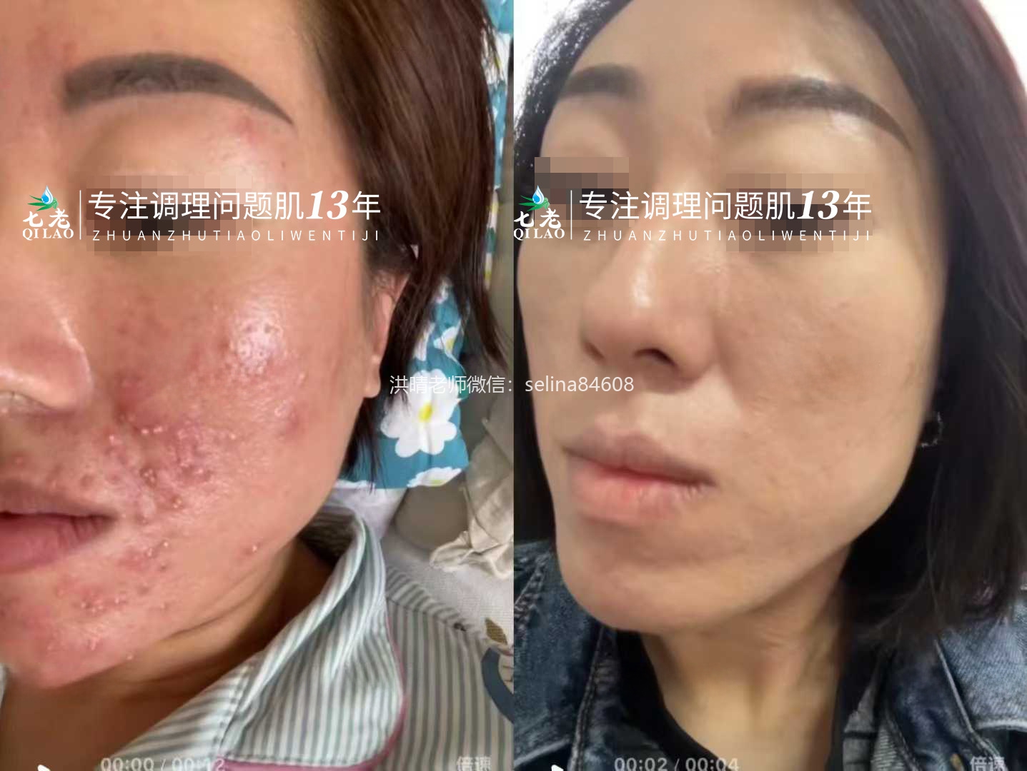 激素脸痘痘修护案例